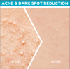 Garnier Fast Clear Serum for Acne Prone Skin 15ml